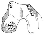 Mosaiplasty
